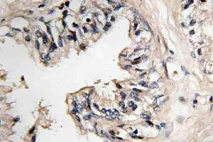 Immunohistochemistry (IHC) analyzes of MRP-S36 antibody in paraffin-embedded human prostate carcinoma tissue. (MRPS36 Antikörper)