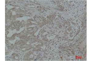 Immunohistochemistry (IHC) analysis of paraffin-embedded Human Breast Carcinoma using Stat3 Polyclonal Antibody. (STAT3 Antikörper)