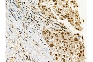 Phospho-p53 (Ser33) Antibody at 1/100 staining Human ovarian cancer by IHC-P.