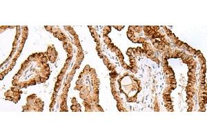 Immunohistochemistry of paraffin-embedded Human thyroid cancer tissue using SAXO2 Polyclonal Antibody at dilution of 1:40(x200) (FAM154B Antikörper)