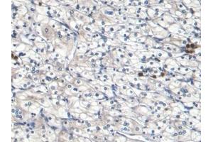 Detection of S100A8 in Human Renal cancer Tissue using Monoclonal Antibody to S100 Calcium Binding Protein A8 (S100A8) (S100A8 Antikörper  (AA 1-93))
