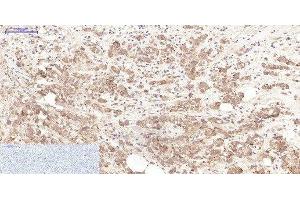 Immunohistochemistry of paraffin-embedded Human breast cancer tissue using LTF Monoclonal Antibody at dilution of 1:200. (Lactoferrin Antikörper)