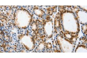 Immunohistochemistry of paraffin-embedded Human thyroid cancer tissue using SELENOS Polyclonal Antibody at dilution 1:40 (Selenoprotein S Antikörper)