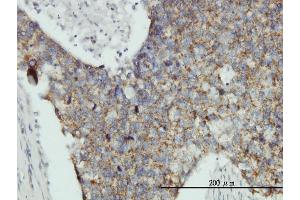 Immunoperoxidase of monoclonal antibody to MRPL12 on formalin-fixed paraffin-embedded human breast cancer tissue. (MRPL12 Antikörper  (AA 1-198))