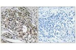 Immunohistochemistry analysis of paraffin-embedded human breast carcinoma tissue using MRPL13 antibody. (MRPL13 Antikörper  (C-Term))