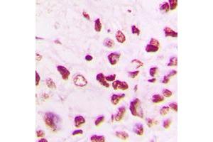 Immunohistochemical analysis of Cullin 1 staining in human lung cancer formalin fixed paraffin embedded tissue section. (Cullin 1 Antikörper  (C-Term))