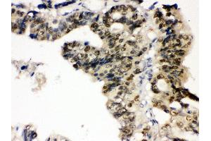 Anti- TCPTP Picoband antibody,IHC(P) IHC(P): Human Intestinal Cancer Tissue (PTPN2 Antikörper  (AA 1-330))