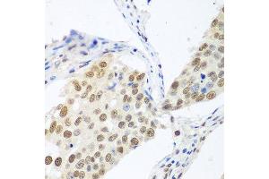Immunohistochemistry of paraffin-embedded human lung cancer using BCAS2 antibody at dilution of 1:100 (40x lens). (BCAS2 Antikörper)