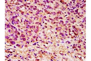 IHC image of ABIN7149816 diluted at 1:200 and staining in paraffin-embedded human ovarian cancer performed on a Leica BondTM system. (DPPA5 Antikörper  (AA 1-116))