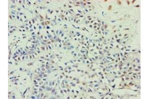Immunohistochemistry of paraffin-embedded human breast cancer using ABIN7144924 at dilution of 1:100 (ABCE1 Antikörper  (AA 320-599))