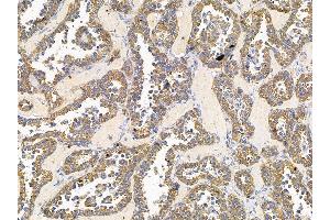 ABIN7095762 and ABIN7099824 at 1/100 staining human ovarian cancer by IHC-P.