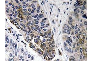 Immunohistochemistry analyzes of IgA antibody in paraffin-embedded human lung carcinoma tissue. (Kaninchen anti-Human IgA Antikörper)