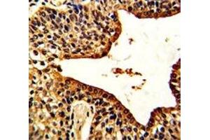 IHC analysis of FFPE human prostate carcinoma with VIP antibody (Vip Antikörper  (AA 139-167))