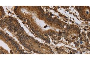 Immunohistochemistry of paraffin-embedded Human colon cancer tissue using ITPR3 Polyclonal Antibody at dilution 1:40