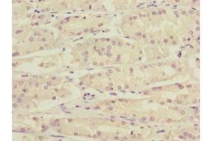 Immunohistochemistry of paraffin-embedded human gastric cancer using ABIN7157720 at dilution of 1:100 (KLF15 Antikörper  (AA 1-260))