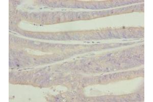 Immunohistochemistry of paraffin-embedded human endometrial cancer using ABIN7174916 at dilution of 1:100 (C9orf43 Antikörper  (AA 267-461))