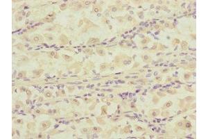 Immunohistochemistry of paraffin-embedded human gastric cancer using ABIN7150823 at dilution of 1:100 (DCTN6 Antikörper  (AA 1-190))