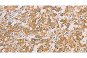 Immunohistochemistry of paraffin-embedded Human thyroid cancer tissue using ZWINT Polyclonal Antibody at dilution 1:50 (ZWINT Antikörper)