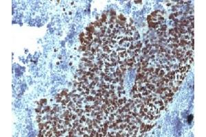 IHC testing of FFPE human prostate carcinoma with FOXA1 antibody (clone FOXA1/1514). (FOXA1 Antikörper  (AA 372-472))