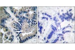 Immunohistochemistry analysis of paraffin-embedded human lung carcinoma tissue, using STAT2 (Ab-690) Antibody. (STAT2 Antikörper  (AA 656-705))