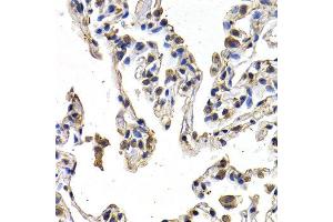 Immunohistochemistry of paraffin-embedded human lung cancer using FIGF antibody at dilution of 1:200 (400x lens). (VEGFD Antikörper)
