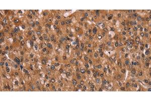 Immunohistochemistry of paraffin-embedded Human liver cancer using HINT1 Polyclonal Antibody at dilution of 1:30 (HINT1 Antikörper)