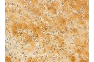 ABIN6257975 and ABIN6274289 at 1/100 staining human hepatocellular carcinoma by IHC-P.