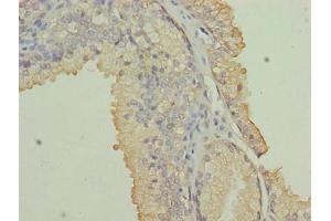 Immunohistochemistry of paraffin-embedded human prostate cancer using ABIN7161717 at dilution of 1:100 (NRARP Antikörper  (AA 1-114))