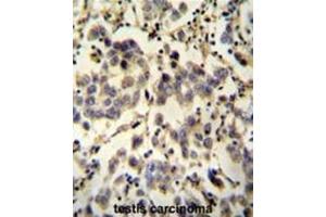 C6orf58 antibody (Center) immunohistochemistry analysis in formalin fixed and paraffin embedded human testis carcinoma followed by peroxidase conjugation of the secondary antibody and DAB staining. (C6ORF58 Antikörper  (Middle Region))