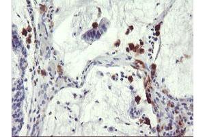 Immunohistochemical staining of paraffin-embedded Adenocarcinoma of Human colon tissue using anti-SDS mouse monoclonal antibody. (serine Dehydratase Antikörper)