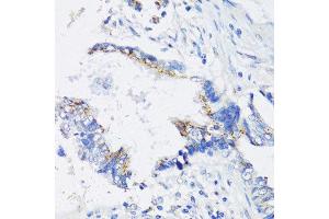 Immunohistochemistry of paraffin-embedded human lung cancer using IKBKE antibody. (IKKi/IKKe Antikörper  (AA 495-716))