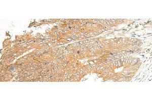 Immunohistochemistry of paraffin-embedded Human colorectal cancer tissue using C5AR2 Polyclonal Antibody at dilution of 1:25(x200) (GPR77 Antikörper)