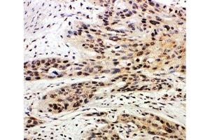 IHC-P: Caspase-14 antibody testing of human esophagus squama cancer tissue