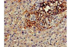 Immunohistochemistry of paraffin-embedded human liver cancer using ABIN7153601 at dilution of 1:100 (GJA8 Antikörper  (AA 286-432))