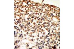 Formalin-fixed and paraffin-embedded human cancer tissue reacted with the primary antibody, which was peroxidase-conjugated to the secondary antibody, followed by AEC staining. (PRKACA Antikörper  (N-Term))