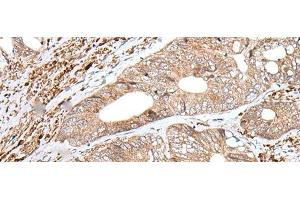 Immunohistochemistry of paraffin-embedded Human colorectal cancer tissue using ENPEP Polyclonal Antibody at dilution of 1:65(x200) (ENPEP Antikörper)