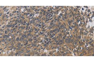 Immunohistochemistry of paraffin-embedded Human cervical cancer using EMC8 Polyclonal Antibody at dilution of 1:30 (COX4NB Antikörper)