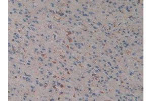 IHC-P analysis of Human Glioma Tissue, with DAB staining. (Prosaposin Antikörper  (AA 17-524))