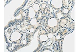 The image on the left is immunohistochemistry of paraffin-embedded Human thyroid cancer tissue using ABIN7192521(SLC7A11 Antibody) at dilution 1/35, on the right is treated with synthetic peptide. (SLC7A11 Antikörper)