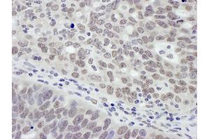Immunohistochemistry (IHC) image for anti-Metastasis Associated 1 (MTA1) (AA 400-450) antibody (ABIN7454605)