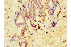 Immunohistochemistry of paraffin-embedded human breast cancer using ABIN7148491 at dilution of 1:100 (GPS1 Antikörper  (AA 222-491))