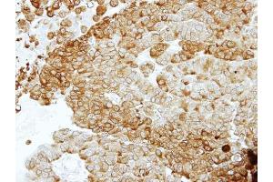 IHC-P Image Immunohistochemical analysis of paraffin-embedded PC14 xenograft, using ENO2, antibody at 1:100 dilution. (ENO2/NSE Antikörper)