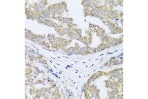 Immunohistochemistry of paraffin-embedded human liver cancer using TIMM10B antibody (ABIN5974609) at dilution of 1/100 (40x lens). (TIMM10B Antikörper)