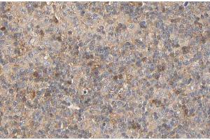 ABIN6267441 at 1/100 staining human Lymphoma tissue sections by IHC-P. (RPS6KB1 Antikörper  (pSer424))
