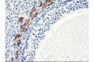 Immunohistochemical staining of paraffin-embedded Adenocarcinoma of Human ovary tissue using anti-ELK3 mouse monoclonal antibody. (ELK3 Antikörper)
