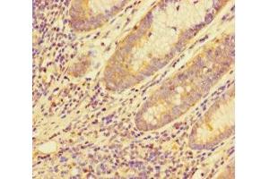 Immunohistochemistry of paraffin-embedded human colon cancer using ABIN7159120 at dilution of 1:100 (MED29 Antikörper  (AA 1-212))