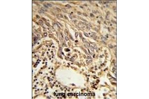 Formalin-fixed and paraffin-embedded human lung carcinoma reacted with EIF4A2 Antibody (C-term), which was peroxidase-conjugated to the secondary antibody, followed by DAB staining. (EIF4A2 Antikörper  (C-Term))