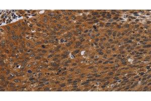 Immunohistochemistry of paraffin-embedded Human cervical cancer tissue using PNOC Polyclonal Antibody at dilution 1:40