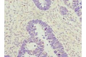 Immunohistochemistry of paraffin-embedded human ovarian cancer using ABIN7176735 at dilution of 1:100 (ZWINT Antikörper  (AA 1-277))