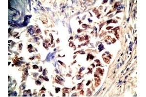 Human lung cancer tissue stained by Rabbit Anti-CRAMP(140-173) (Mouse) Antibody (Cathelicidin Antikörper  (AA 140-173))